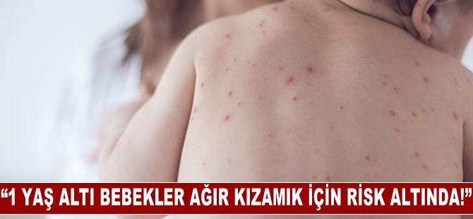 “1 yaş altı bebekler ağır kızamık için risk altında!”